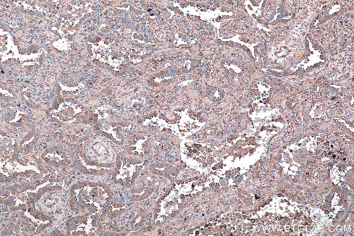 Immunohistochemistry (IHC) staining of human lung cancer tissue using CRMP1 Monoclonal antibody (68021-1-Ig)