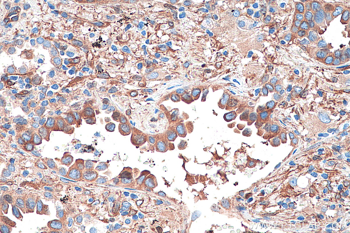 Immunohistochemistry (IHC) staining of human lung cancer tissue using CRMP1 Monoclonal antibody (68021-1-Ig)