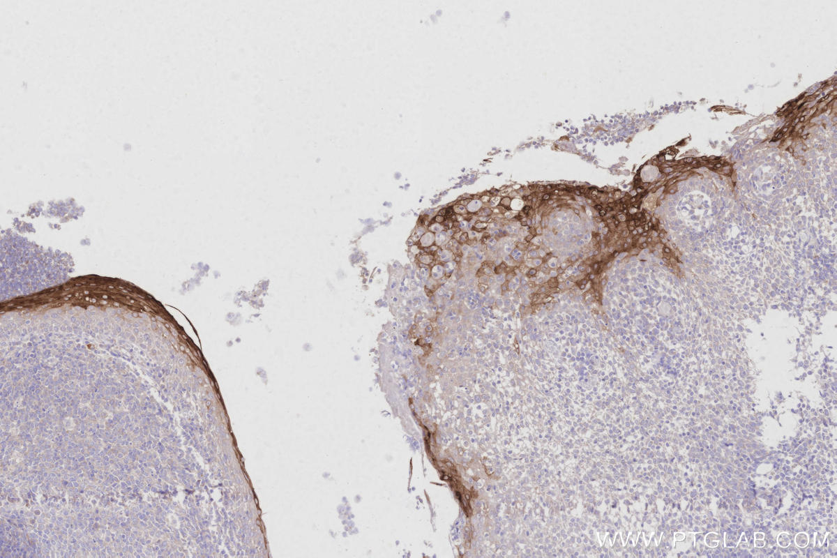 Immunohistochemical analysis of paraffin-embedded human tonsillitis tissue slide using 11799-1-AP (CRNN antibody) at dilution of 1:1000 (under 10x lens). Heat mediated antigen retrieval with Tris-EDTA buffer (pH 9.0). Immunohistochemistry (IHC) staining of human tonsillitis tissue using CRNN Polyclonal antibody (11799-1-AP)