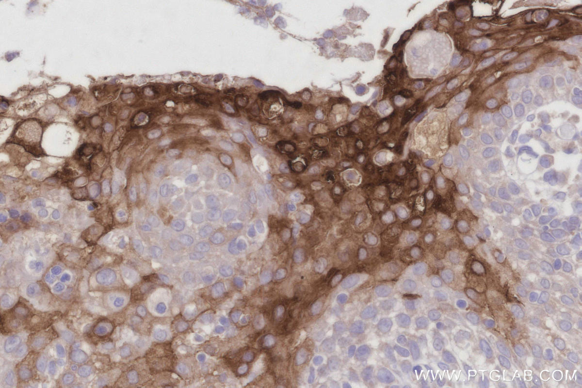 Immunohistochemical analysis of paraffin-embedded human tonsillitis tissue slide using 11799-1-AP (CRNN antibody) at dilution of 1:1000 (under 40x lens). Heat mediated antigen retrieval with Tris-EDTA buffer (pH 9.0). Immunohistochemistry (IHC) staining of human tonsillitis tissue using CRNN Polyclonal antibody (11799-1-AP)