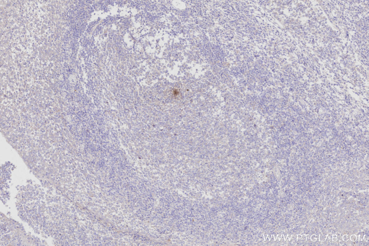 Immunohistochemistry (IHC) staining of human tonsillitis tissue using CRNN Polyclonal antibody (11799-1-AP)