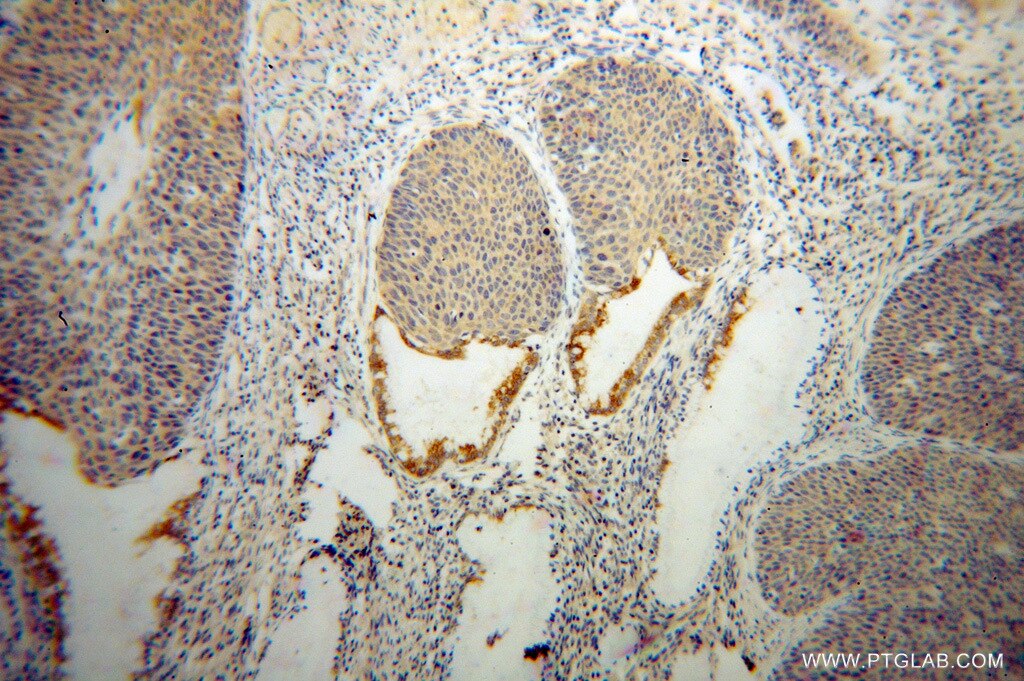 Immunohistochemistry (IHC) staining of human cervical cancer tissue using CRNN Polyclonal antibody (11799-1-AP)