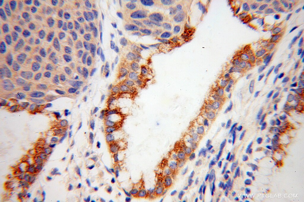 Immunohistochemistry (IHC) staining of human cervical cancer tissue using CRNN Polyclonal antibody (11799-1-AP)