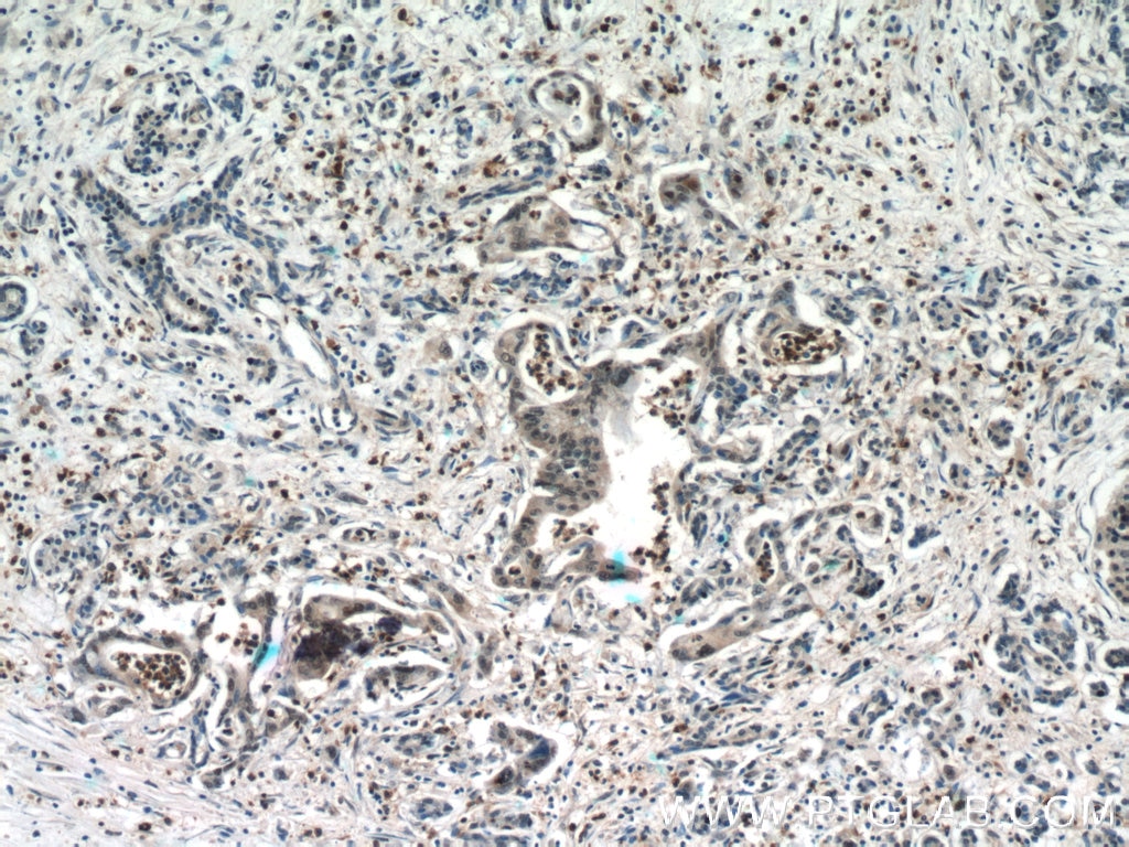 Immunohistochemistry (IHC) staining of human pancreas cancer tissue using CROP Polyclonal antibody (14504-1-AP)