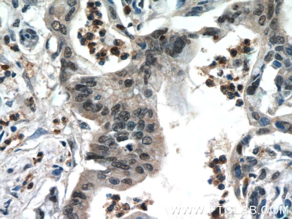 Immunohistochemistry (IHC) staining of human pancreas cancer tissue using CROP Polyclonal antibody (14504-1-AP)