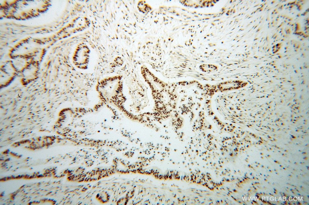Immunohistochemistry (IHC) staining of human pancreas cancer tissue using CROP Polyclonal antibody (14504-1-AP)
