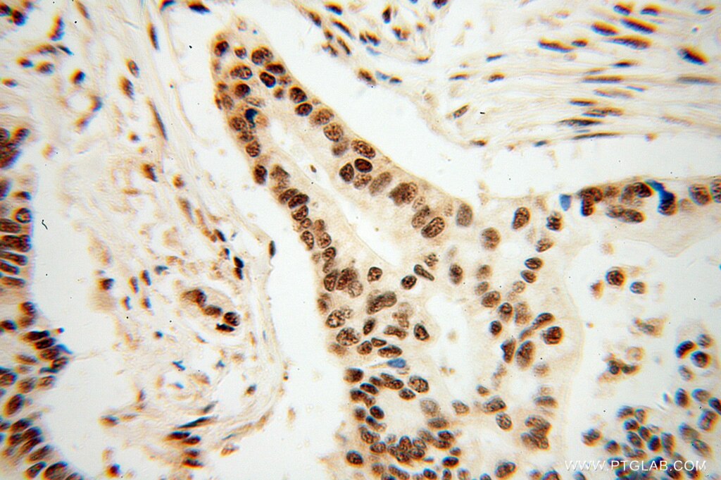 Immunohistochemistry (IHC) staining of human pancreas cancer tissue using CROP Polyclonal antibody (14504-1-AP)