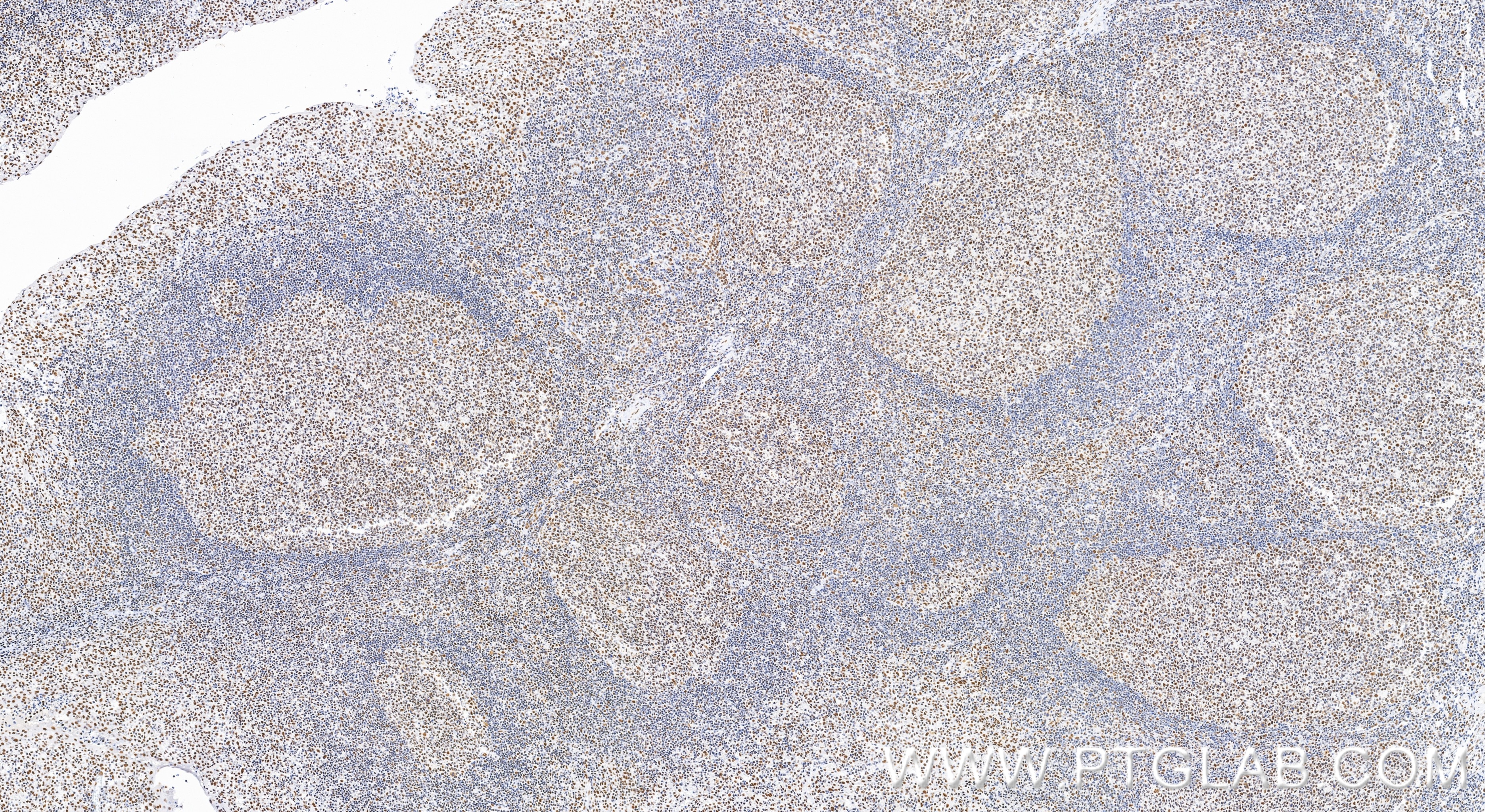 IHC staining of human tonsillitis using 86690-1-RR Immunohistochemistry (IHC) staining of human tonsillitis tissue using CROP Recombinant monoclonal antibody (86690-1-RR)