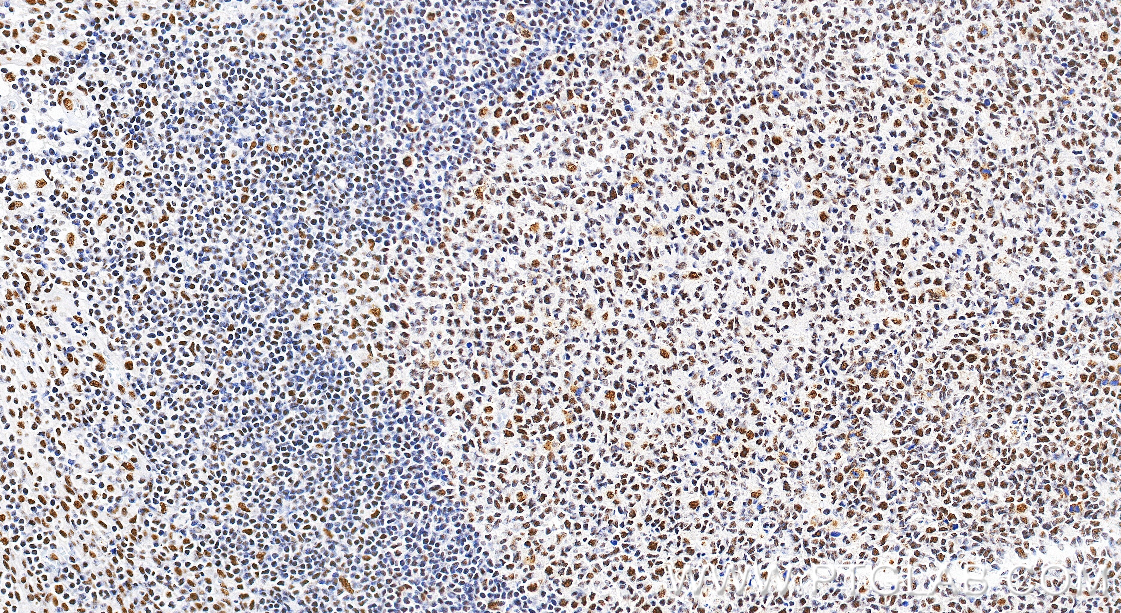 IHC staining of human tonsillitis using 86690-1-RR Immunohistochemistry (IHC) staining of human tonsillitis tissue using CROP Recombinant monoclonal antibody (86690-1-RR)