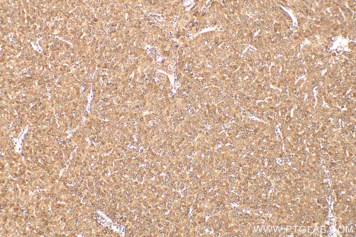Immunohistochemistry (IHC) staining of human liver cancer tissue using CROT Polyclonal antibody (13543-1-AP)