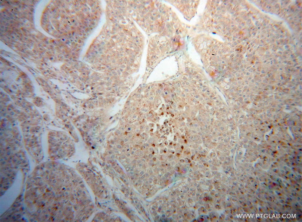 Immunohistochemistry (IHC) staining of human liver cancer tissue using CROT Polyclonal antibody (13543-1-AP)