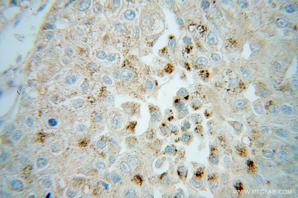 Immunohistochemistry (IHC) staining of human liver cancer tissue using CROT Polyclonal antibody (13543-1-AP)