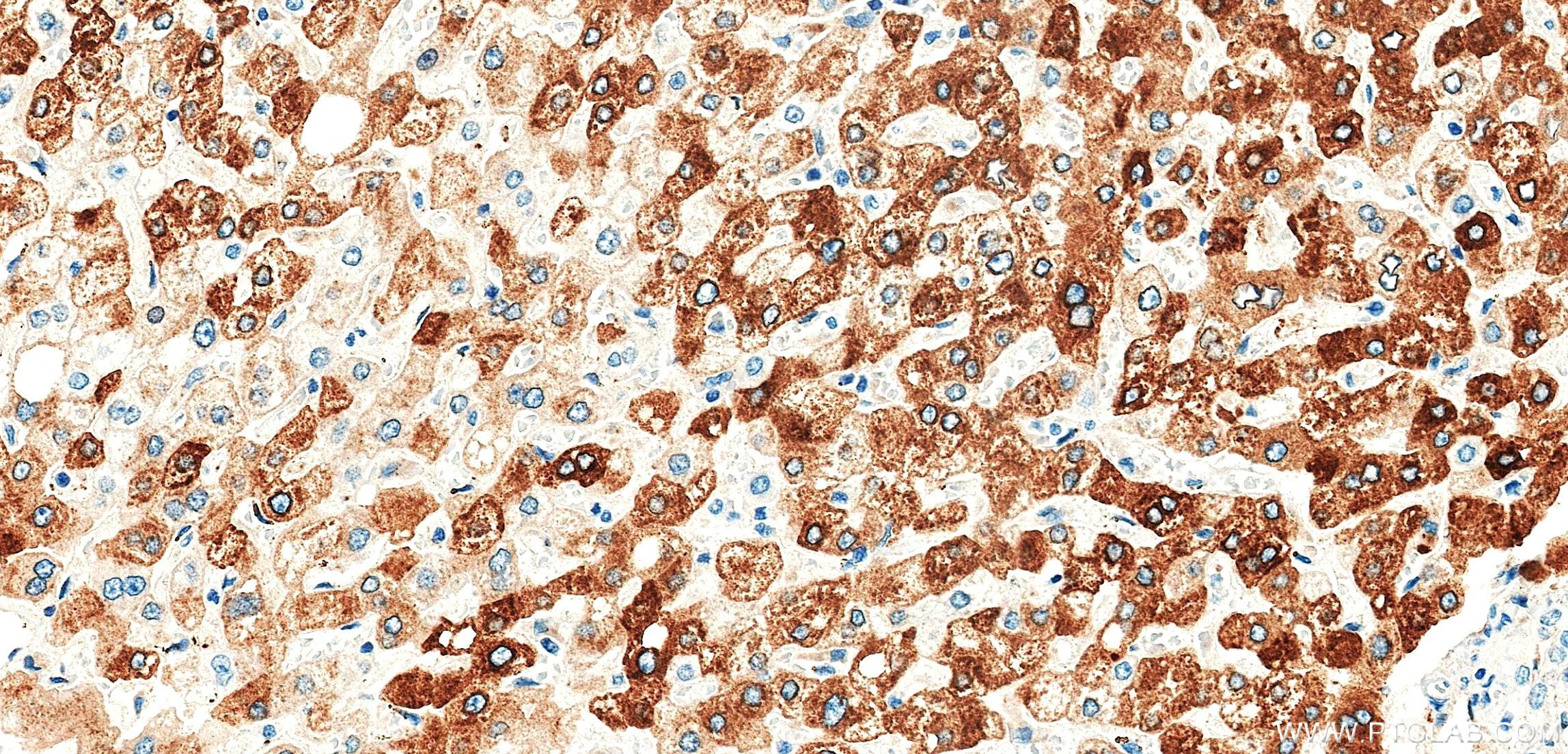 IHC staining of human liver using 86912-6-RR (same clone as 86912-6-PBS) Immunohistochemistry (IHC) staining of human liver tissue using C-Reactive Protein/CRP Recombinant monoclonal anti (86912-6-RR)