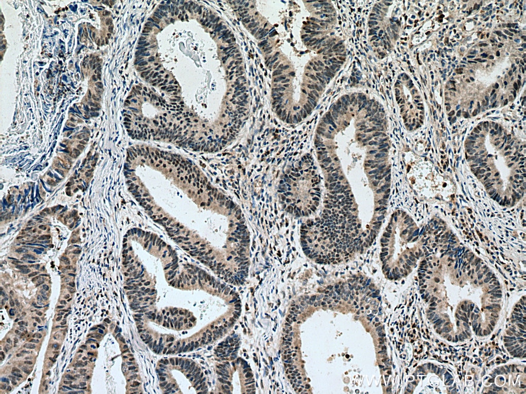 Immunohistochemistry (IHC) staining of human colon cancer tissue using TORC1/CRTC1 Polyclonal antibody (10441-1-AP)