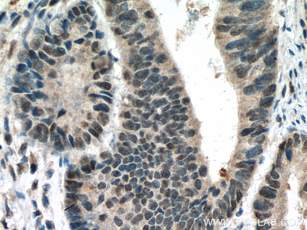 Immunohistochemistry (IHC) staining of human colon cancer tissue using TORC1/CRTC1 Polyclonal antibody (10441-1-AP)