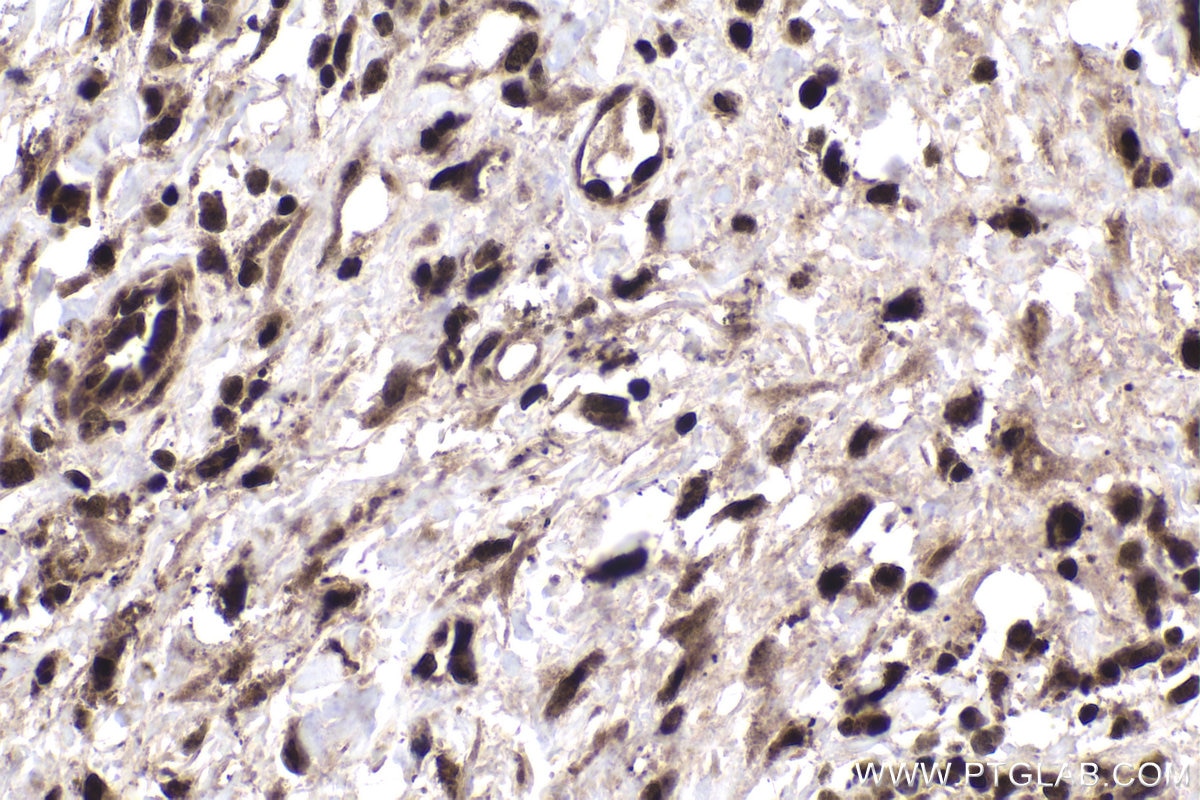 Immunohistochemistry (IHC) staining of human skin cancer tissue using CRTC2,TORC2 Polyclonal antibody (12497-1-AP)