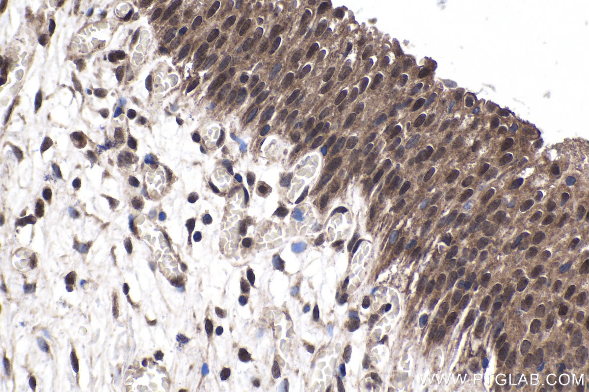 Immunohistochemistry (IHC) staining of human urothelial carcinoma tissue using CRTC2,TORC2 Polyclonal antibody (12497-1-AP)