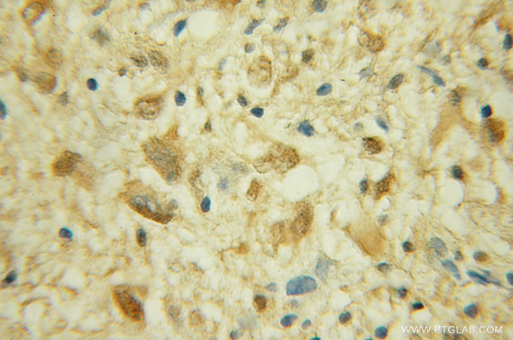 Immunohistochemistry (IHC) staining of human gliomas tissue using CRTC2,TORC2 Polyclonal antibody (12497-1-AP)