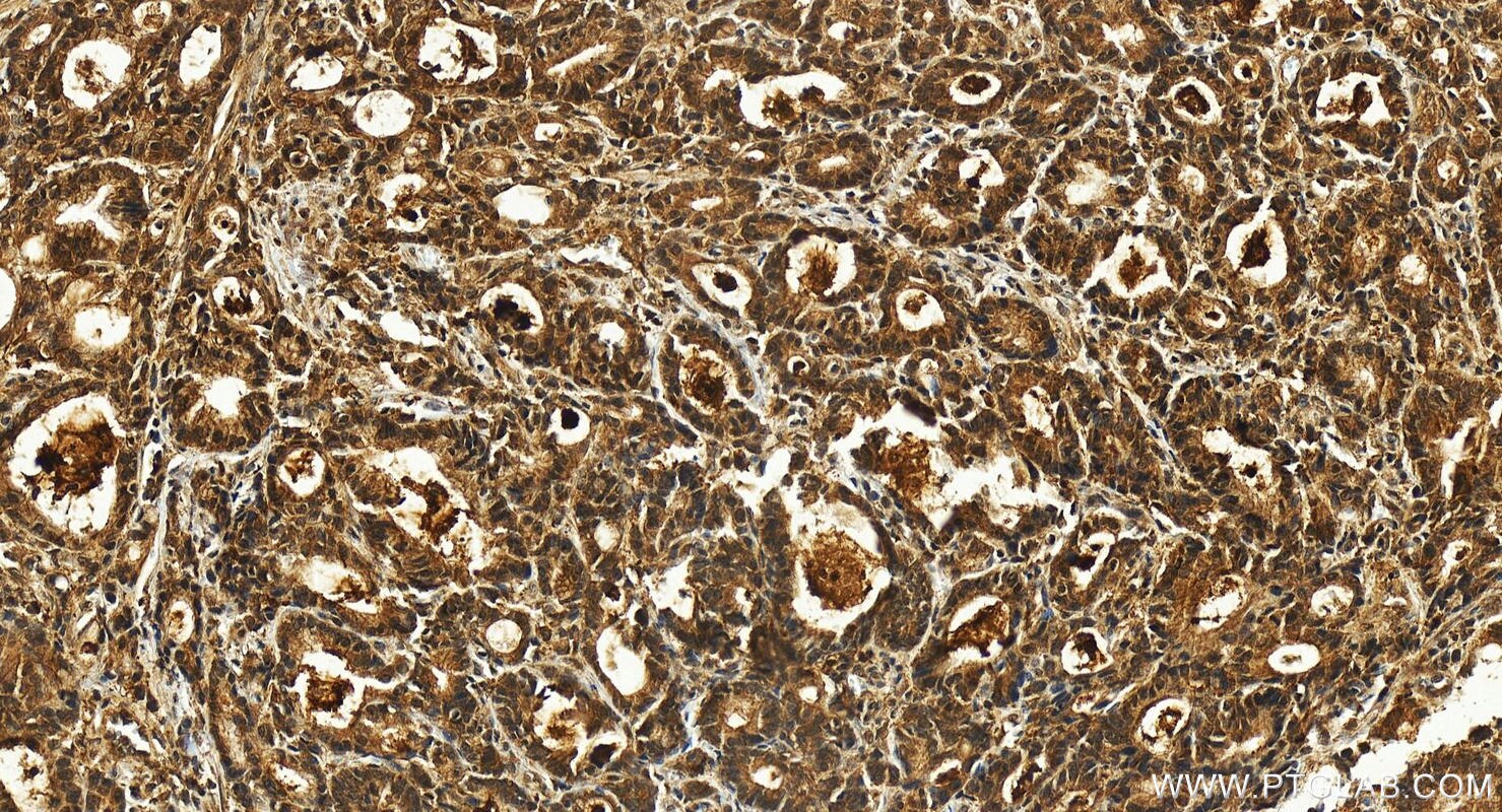 Immunohistochemistry (IHC) staining of human stomach cancer tissue using CRTC3 Polyclonal antibody (25476-1-AP)