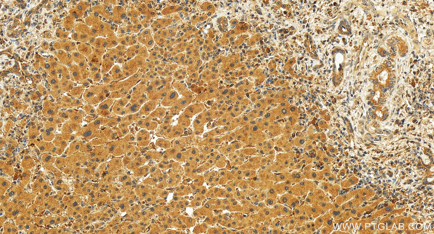 Immunohistochemistry (IHC) staining of human intrahepatic cholangiocarcinoma tissue using CRTC3 Polyclonal antibody (25476-1-AP)