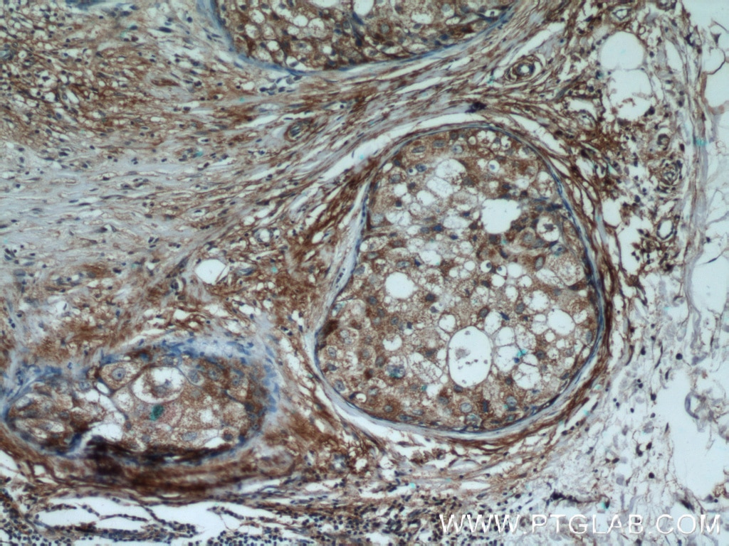 IHC staining of human breast cancer using 13474-1-AP