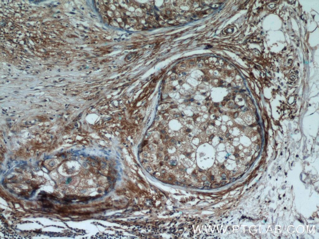 Immunohistochemistry (IHC) staining of human breast cancer tissue using Cryptochrome 1 Polyclonal antibody (13474-1-AP)