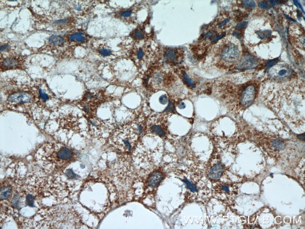 Immunohistochemistry (IHC) staining of human breast cancer tissue using Cryptochrome 1 Polyclonal antibody (13474-1-AP)