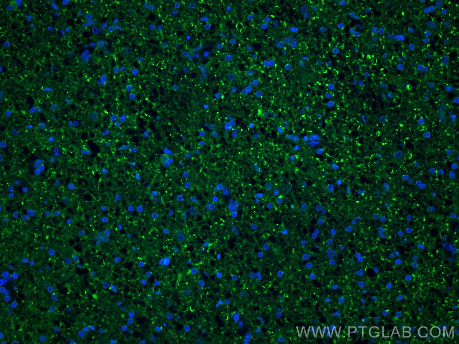 IF Staining of human gliomas using 12495-1-AP