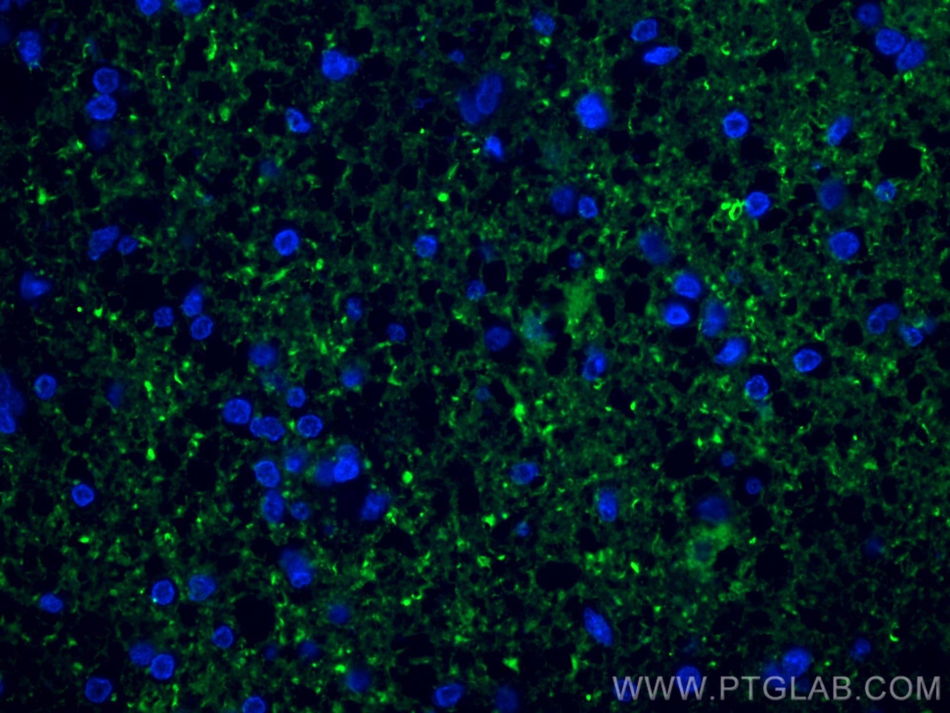 Immunofluorescence (IF) / fluorescent staining of human gliomas tissue using Mu Crystallin Polyclonal antibody (12495-1-AP)