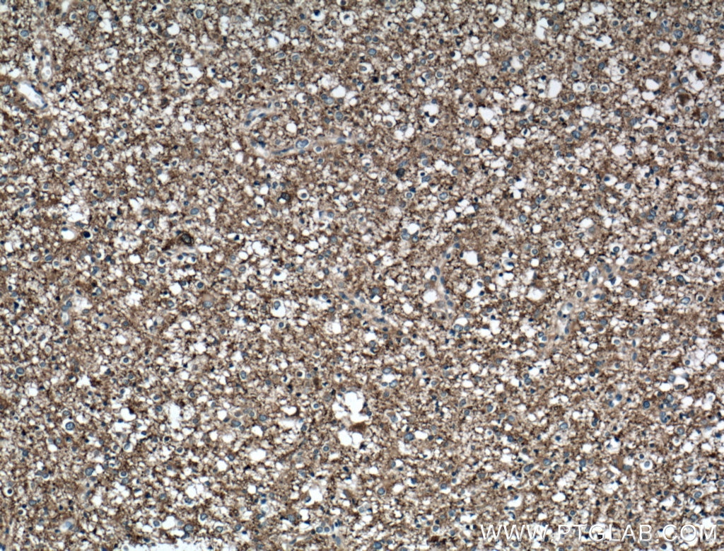 Immunohistochemistry (IHC) staining of human gliomas tissue using Mu Crystallin Polyclonal antibody (12495-1-AP)