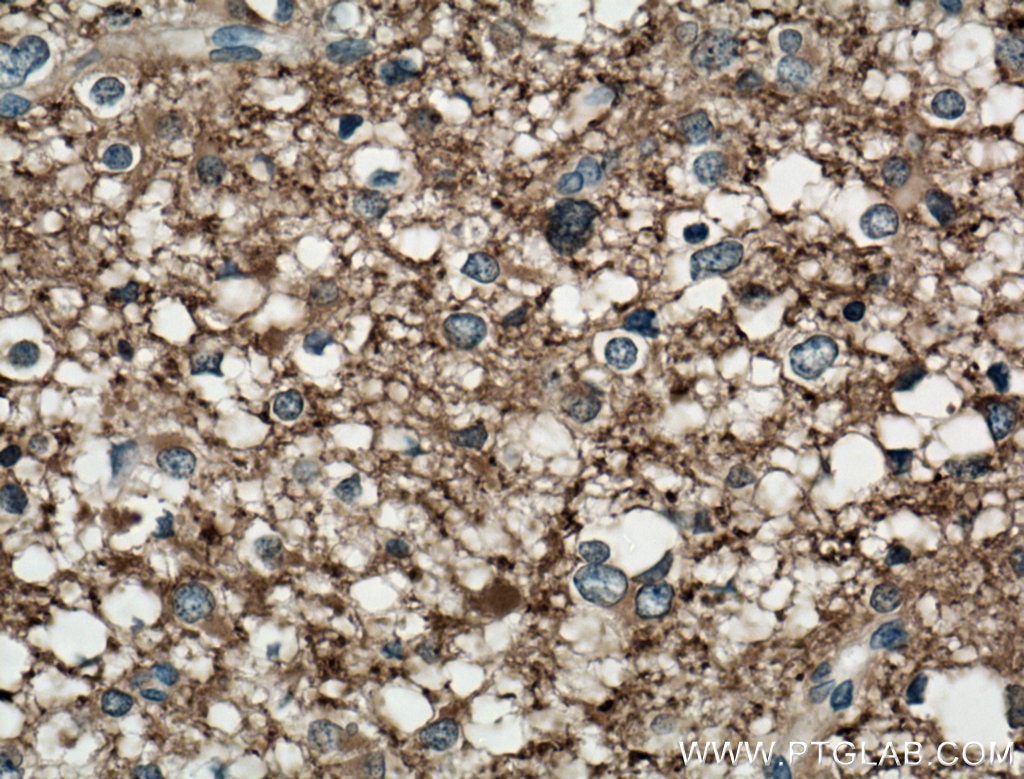 Immunohistochemistry (IHC) staining of human gliomas tissue using Mu Crystallin Polyclonal antibody (12495-1-AP)