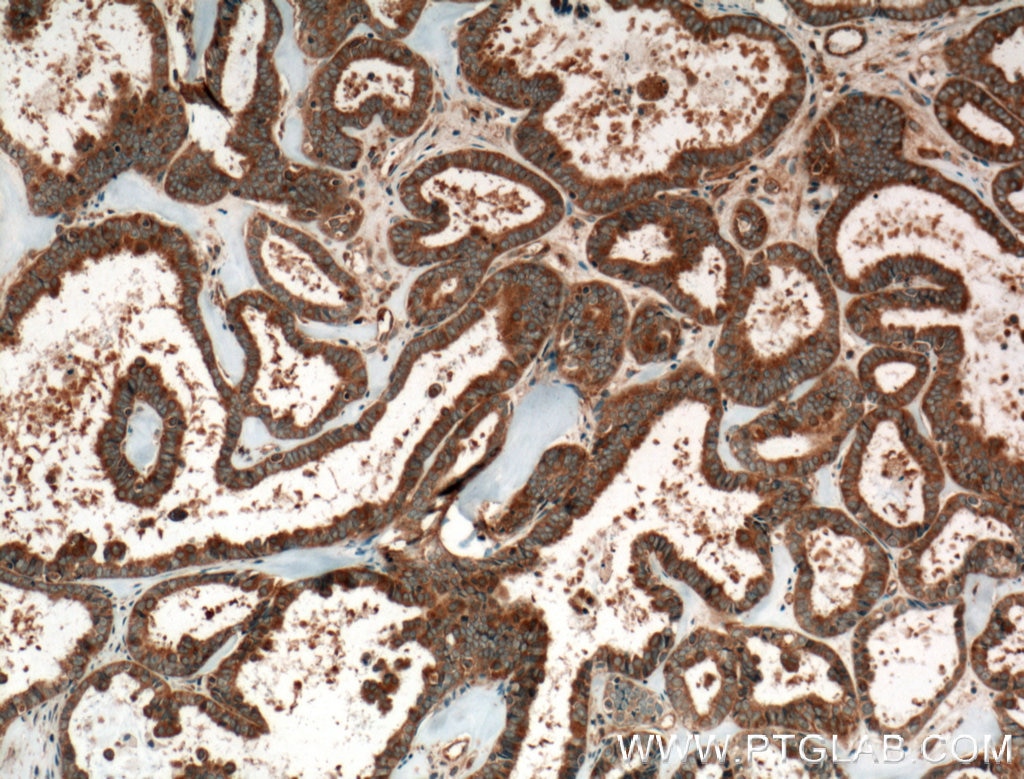 Immunohistochemistry (IHC) staining of human ovary tumor tissue using CRYZL1 Polyclonal antibody (16894-1-AP)