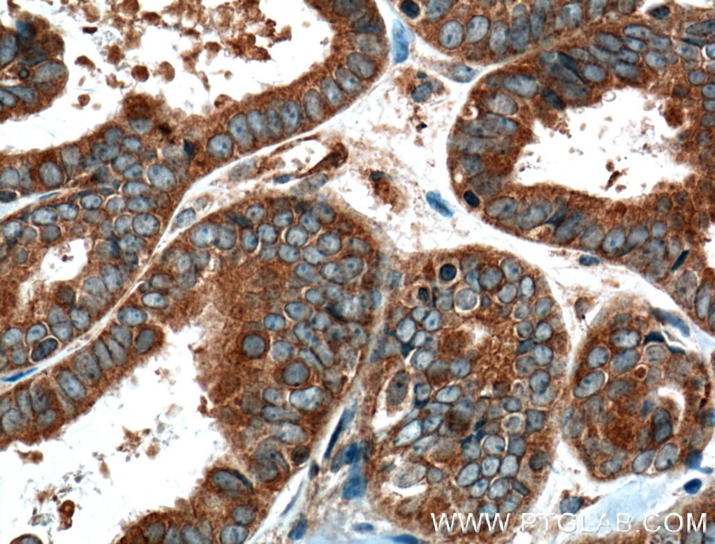 IHC staining of human ovary tumor using 16894-1-AP