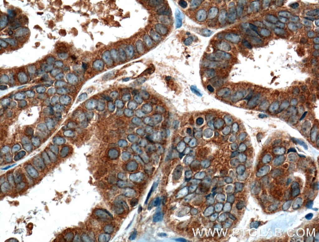 Immunohistochemistry (IHC) staining of human ovary tumor tissue using CRYZL1 Polyclonal antibody (16894-1-AP)