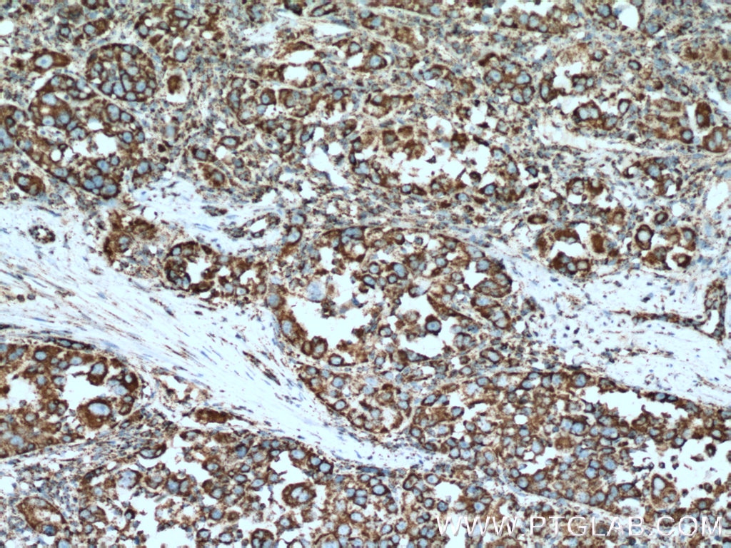 Immunohistochemistry (IHC) staining of human liver cancer tissue using Citrate synthase Polyclonal antibody (16131-1-AP)