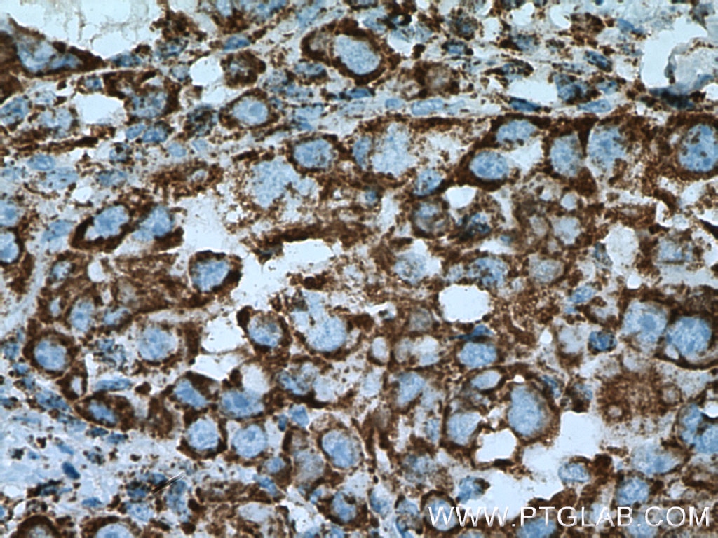 Immunohistochemistry (IHC) staining of human liver cancer tissue using Citrate synthase Polyclonal antibody (16131-1-AP)