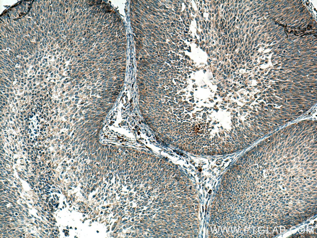 IHC staining of human cervical cancer using 22870-1-AP