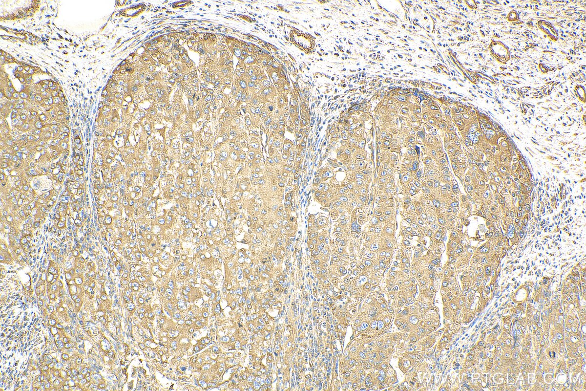 Immunohistochemistry (IHC) staining of human liver cancer tissue using CSDE1 Polyclonal antibody (13319-1-AP)