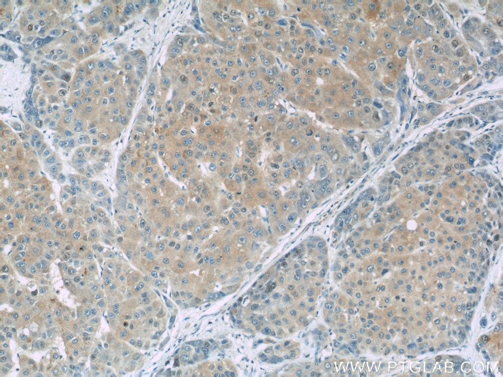 Immunohistochemistry (IHC) staining of human liver cancer tissue using Gamma Cystathionase Monoclonal antibody (60234-1-Ig)