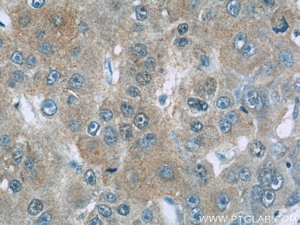 Immunohistochemistry (IHC) staining of human liver cancer tissue using Gamma Cystathionase Monoclonal antibody (60234-1-Ig)