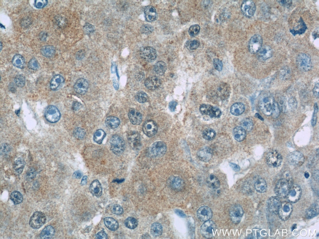 IHC staining of human liver cancer using 60234-1-Ig