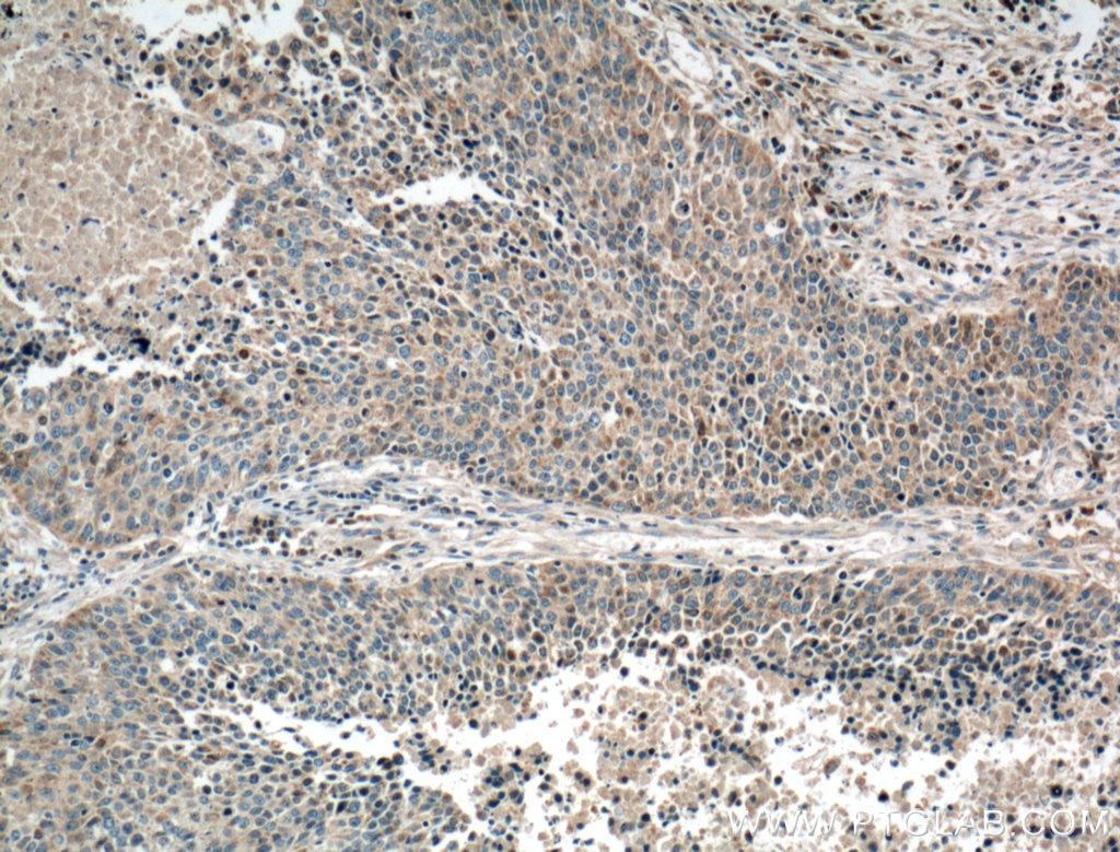 Immunohistochemistry (IHC) staining of human lung cancer tissue using Gamma Cystathionase Monoclonal antibody (60234-1-Ig)