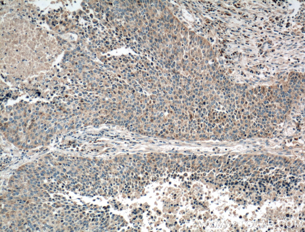 IHC staining of human lung cancer using 60234-1-Ig