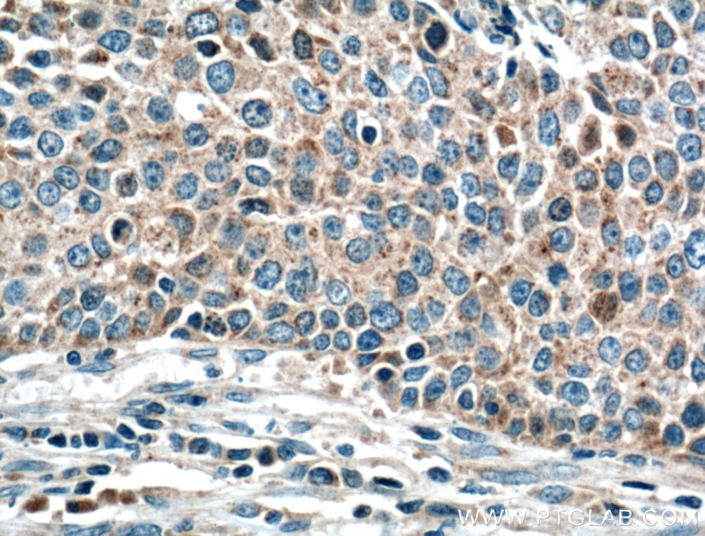 Immunohistochemistry (IHC) staining of human lung cancer tissue using Gamma Cystathionase Monoclonal antibody (60234-1-Ig)