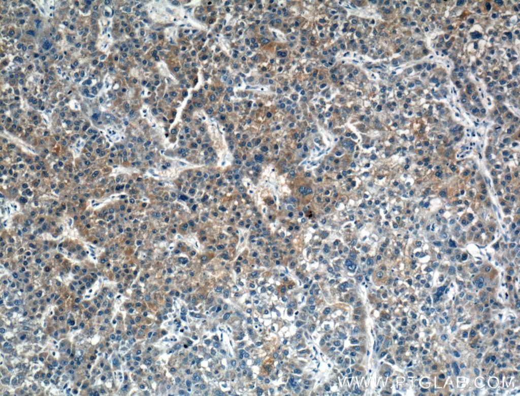 Immunohistochemistry (IHC) staining of human liver cancer tissue using Gamma Cystathionase Monoclonal antibody (60234-1-Ig)