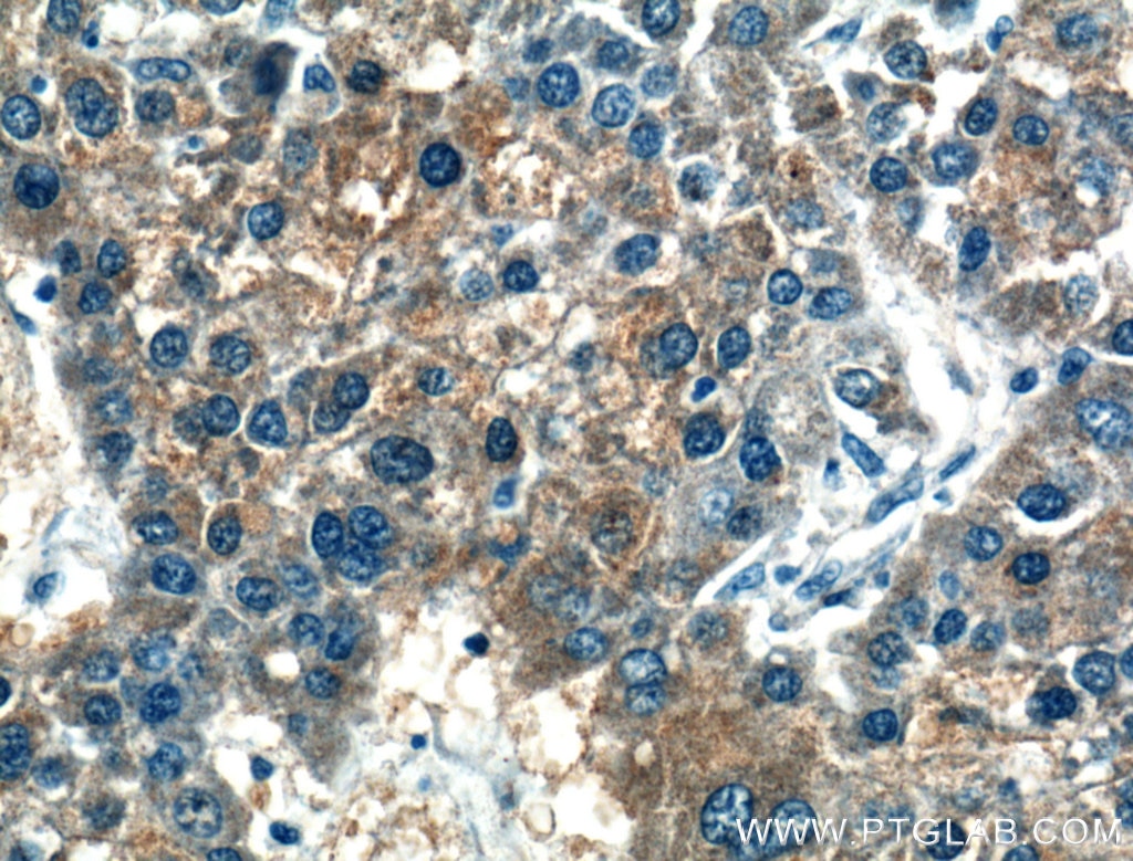 IHC staining of human liver cancer using 60234-1-Ig