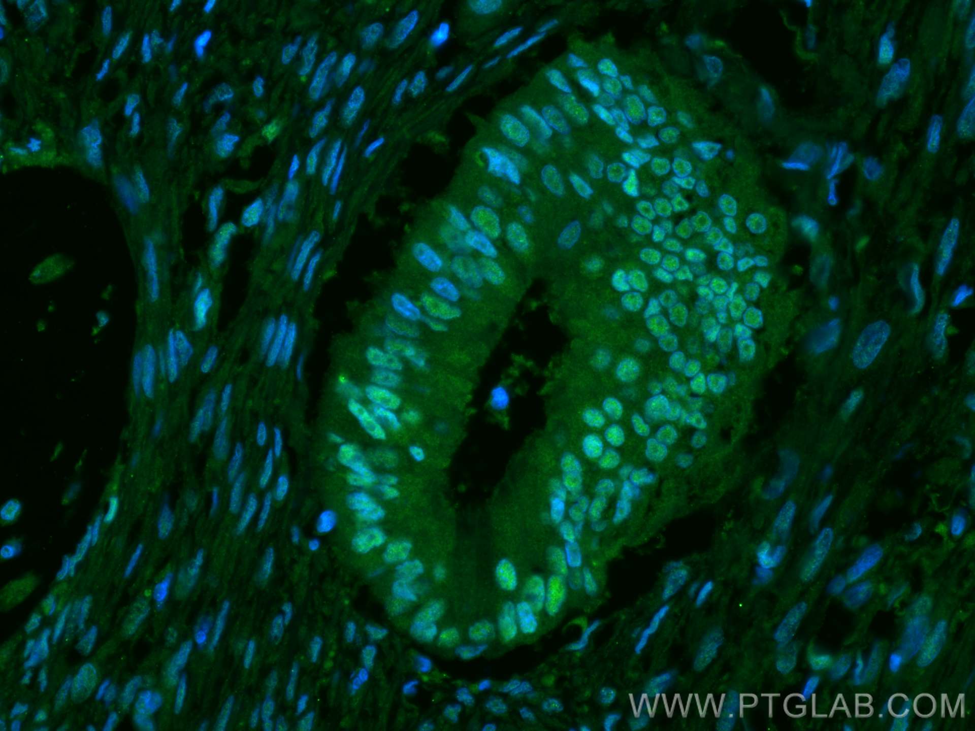 Immunofluorescence (IF) / fluorescent staining of human colon cancer tissue using CSE1L Monoclonal antibody (67306-1-Ig)