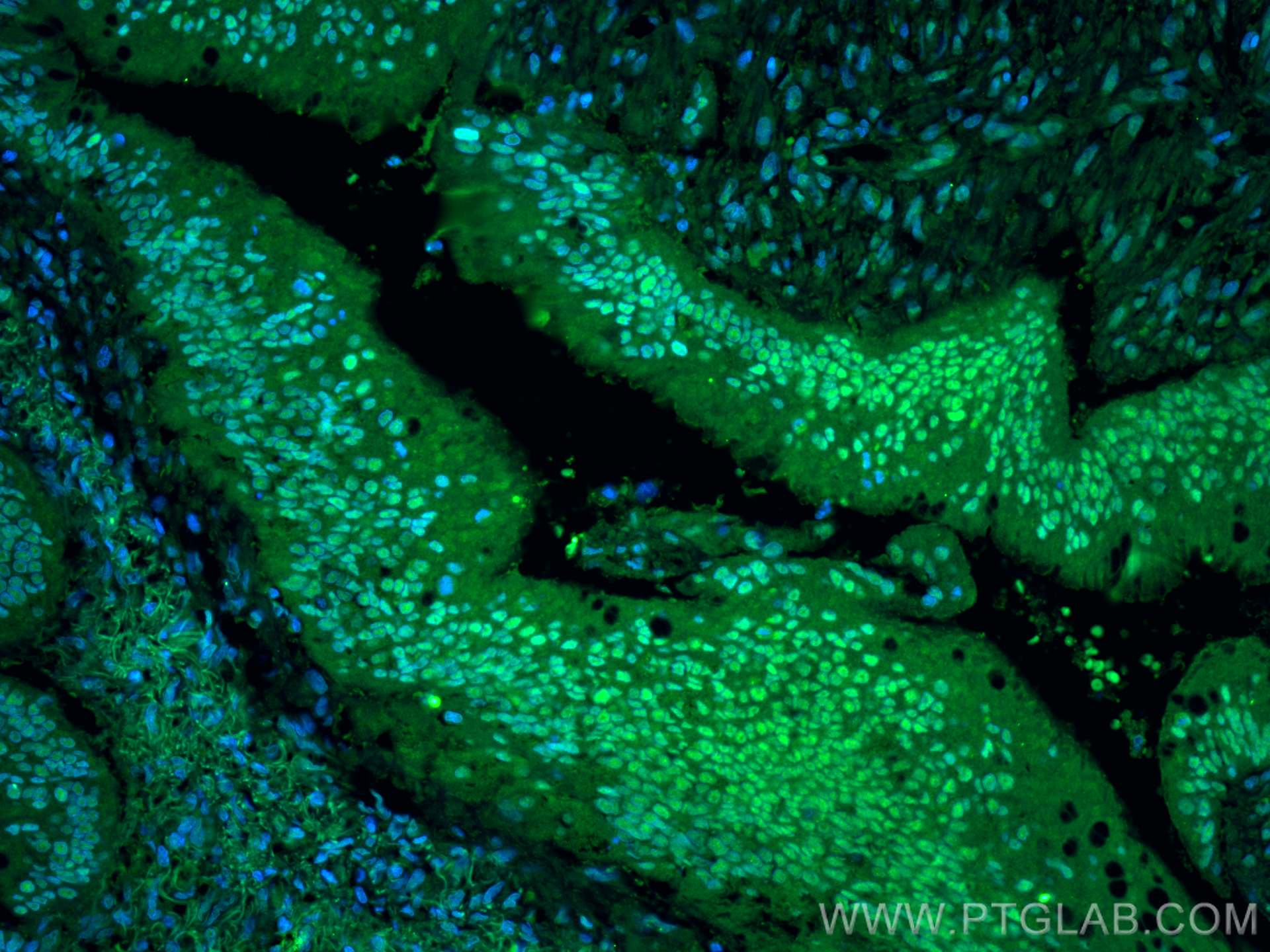 Immunofluorescence (IF) / fluorescent staining of human colon cancer tissue using CSE1L Monoclonal antibody (67306-1-Ig)