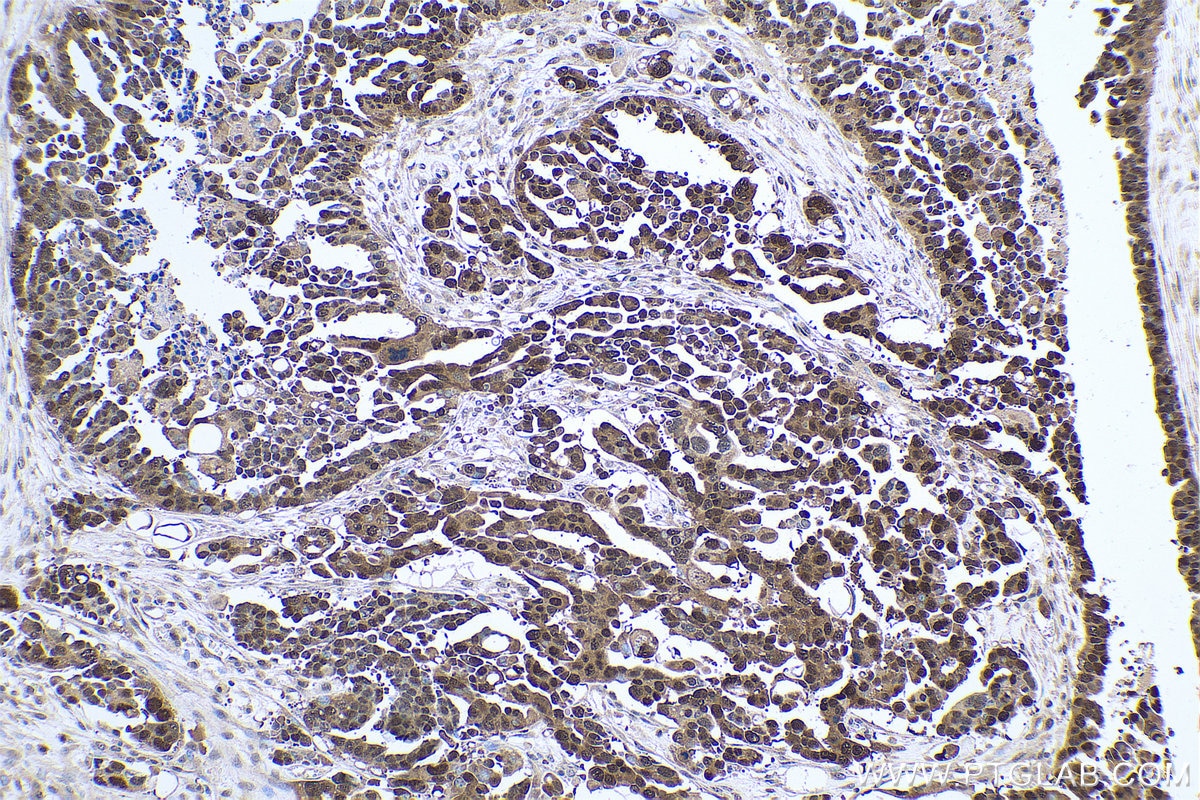 Immunohistochemistry (IHC) staining of human colon cancer tissue using CSE1L Monoclonal antibody (67306-1-Ig)