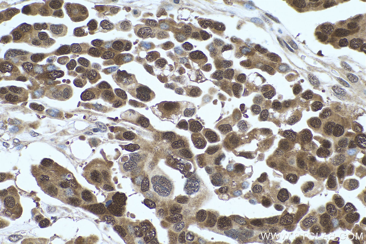 Immunohistochemistry (IHC) staining of human colon cancer tissue using CSE1L Monoclonal antibody (67306-1-Ig)